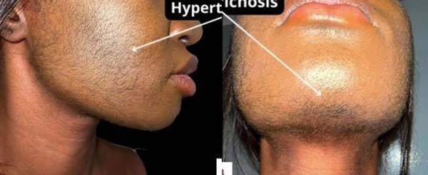 탈모를 완화하기 위해 미녹시딜을 사용했다가 일시적으로 다모증을 겪은 프랑스 여성 A씨. /사진=미국 사례 보고서 저널