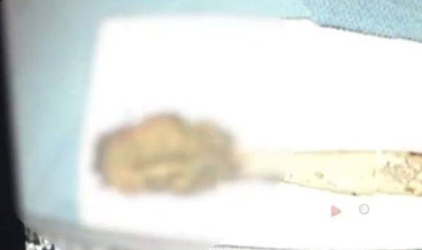 중국의 한 60대 남성이 극심한 가슴 통증을 호소해 병원을 찾았다가 발견된 칫솔. /사진=중화왕