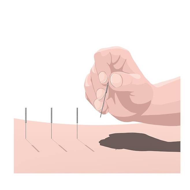 17일 경찰에 따르면, 제주도 자치경찰단은 의료법 위반 혐의를 받는 70대 남성 A씨를 최근 구속송치했다. 2022년부터 약 4년간 전국을 돌며 무면허 침 시술을 자행해 폭리를 취하고 환자들로 하여금 각종 부작용을 겪게한 혐의다. ⓒ연합뉴스=OGQ 