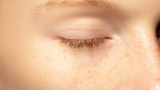 기미와 주근깨는 색소의 깊이와 치료 방법에서 차이를 보인다|출처: 게티이미지뱅크