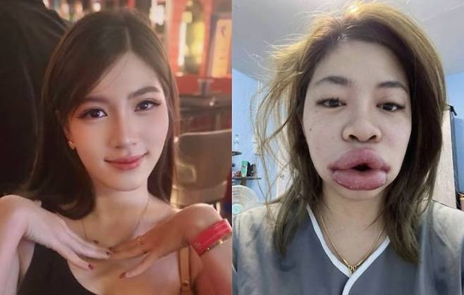 태국의 한 여성이 입술 필러 시술 후 히알루론산 알레르기 반응으로 입술과 얼굴이 심하게 부어올랐다. 그는 자신의 SNS에 부작용 사진을 공개하며, 시술 전 알레르기 검사의 중요성을 강조했다. (사진=SNS 캡처)