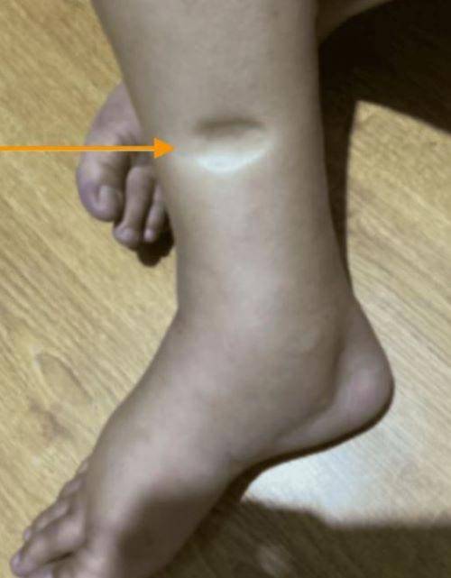 함유부종이 나타난 여성의 다리./사진=큐레우스