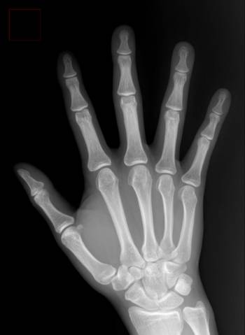 손 X선 사진./사진=바른세상병원