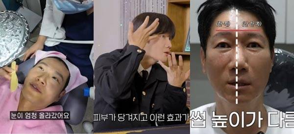 (왼쪽부터)리프팅 시술을 받는 김종국, 시술 후기를 전하는 이용진과 지석진./사진='김종국 GYM JONG KOOK', '이용진 유튜브 LEEYONGJIN YouTube', '지편한세상' 유튜브 캡처