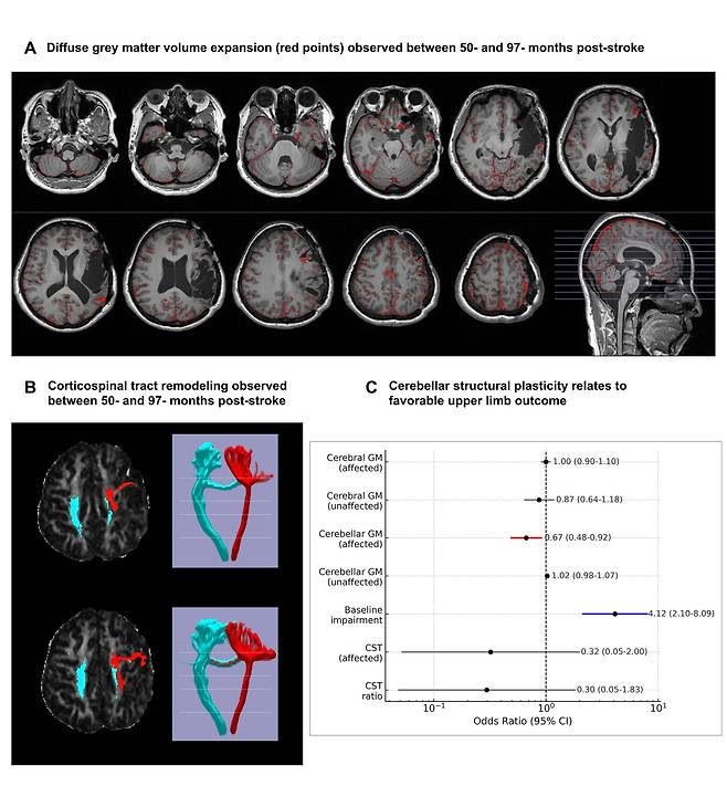 만성기 뇌졸중 환자에서의 뇌 구조 재구성과 상지 기능 회복 간의 연관성 A. 뇌졸중 발생 후 50~97개월 사이에 관찰된 회백질(Grey Matter) 용적 증가를 빨간 점으로 표시한 MRI 영상. 일부 환자에서는 시간이 오래 지난 후에도 뇌가 구조적으로 회복되는 신경 가소성(neuroplasticity)을 보임 B. 같은 기간 동안 재구성된 피질척수로(Corticospinal Tract). 운동 신호 전달 경로인 피질척수로도 구조적으로 변화할 수 있음을 시사 C. 각 구조 지표와 상지 기능 회복 간의 통계적 연관성을 나타낸 그래프. 병변과 연결된 소뇌측 회백질의 증가는 손 기능 회복에 있어 나쁜 예후와 유의한 음의 상관관계를 보였으며(OR=0.67, P=0.01), 이는 소뇌의 구조적 변화가 나쁜 예후의 위험을 낮추는 보호 요인으로 작용할 수 있음을 시사