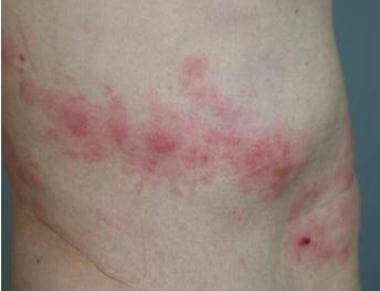 대상포진(사진=고려대 의료원)