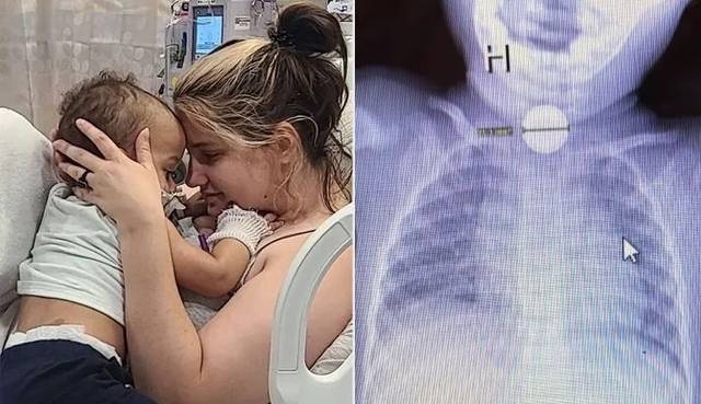 병원이 오진한 18개월 유아가 배터리를 삼킨 사실이 확인돼 긴급 수술로 목숨을 건졌다. 케네디뉴스&미디어