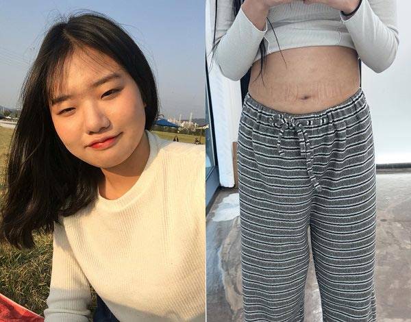 다이어트 전 이채원씨./사진=이채원씨 제공