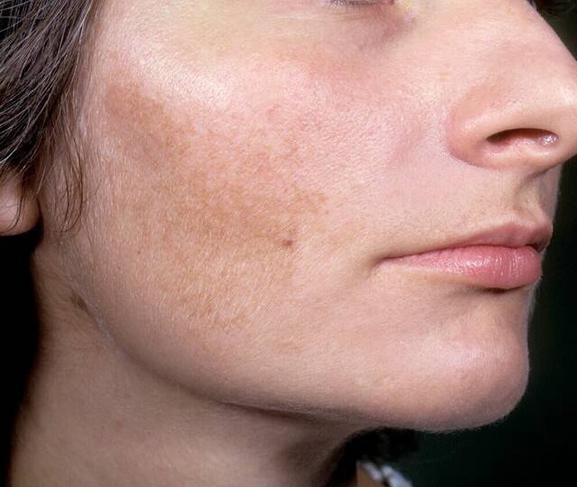 색소 침착 피부 | 출처: 클립아트코리아