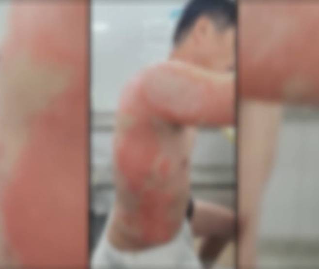 피해자 측이 공개한 전신화상을 입은 모습. /SBS