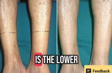 당뇨병성 신경병증으로 인한 탈모가 나타난 사람의 팔./사진=케네스 할리스 틱톡 채널 캡처