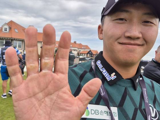 김홍택이 더 르네상스 클럽에서 굳은 살이 박힌 손을 보이고 있다. 성호준 기자