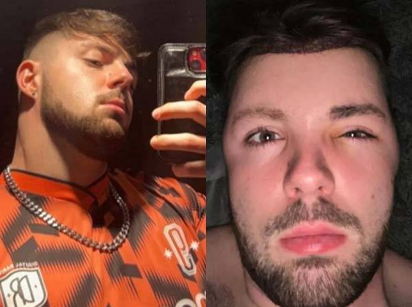 영국의 한 20대 남성이 모발 이식을 받고 성관계를 한 후 심각한 부종을 겪은 사연이 공개됐다. 모발 이식을 받기 전(왼)과 후(오) 남성의 모습./사진=더 선