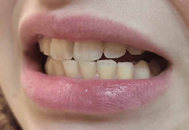 19세 여성이 겪은 만성 피로와 통증의 원인이 수면 중 무의식적으로 나타난 이갈이로 밝혀졌다. 맞춤형 마우스피스와 약물 조정 등을 통해 증상이 호전됐다. (사진=큐어어스)