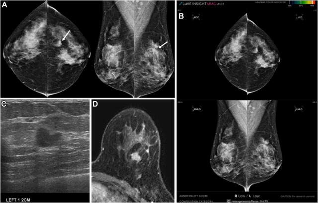 A. 유방촬영술에서 좌측 유방의 상외측에 종괴가 있어서 영상의학과 의사가 암이 있다고 판단하였음 (화살표). B. AI에서는 암이 없다고 판단하였음. C·D. 초음파와 MRI에서 1.1cm의 종괴가 있는 것을 확인하였으며 수술 결과 1.1센티의 유방암이었음. AI가 놓친 이유는 치밀 유방 때문으로 연구진은 판단했다. 논문 발췌