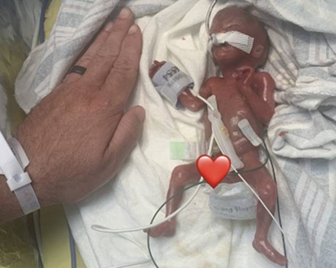 21주 만에 태어나 세계에서 가장 어린 조산아로 기네스북에 등재된 아이가 무사히 첫 돌을 맞았다./사진=기네스 세계기록 홈페이지