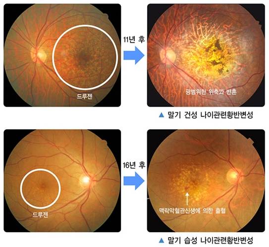 말기에 다다른 나이관련 황반변성의 병변. /사진=질병관리청 국가건강정보포털