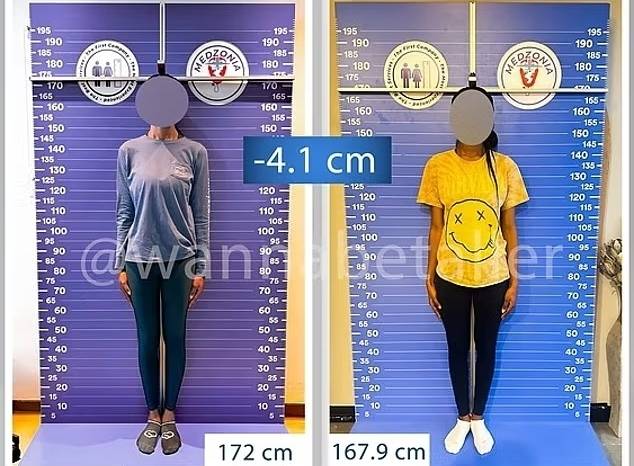 24일(현지시간) 데일리메일에 따르면 최근 튀르키예에서는 이른바 ‘키 축소 수술’이 새로운 의료 관광 상품으로 자리 잡고 있다. 사진은 튀르키예 이스탄불의 ‘하이트 리덕션’에서 키 축소술을 받고 키를 4.1㎝ 줄인 여성 환자. 하이트 리덕션 자료