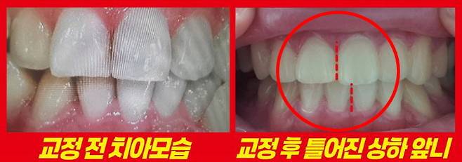 성남시의 B치과에서 교정 치료를 받은 A씨의 치아 사진