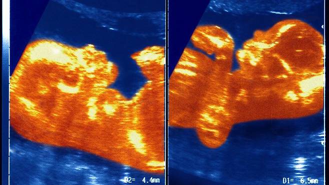 이란성 쌍둥이는 서로의 DNA를 약 50% 정도만 공유하기에 일반적인 형제자매와 마찬가지로 유전적으로 서로 크게 다르다