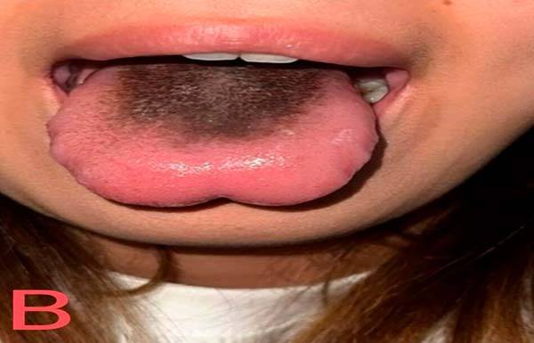 결핵 치료를 위해 항생제를 먹은 후 혀가 까맣게 변한 모습./사진=임상사레보고저널