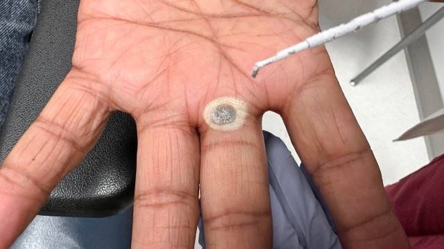 사마귀는 발병 초기 대응이 중요하다|출처: 클립아트코리아