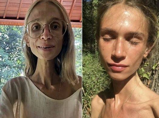 과일주의 식단을 고수하다가 영양실조로 사망한 폴란드 여성 칼로리나 크시자크. 칼로리나 크시자크 인스타그램