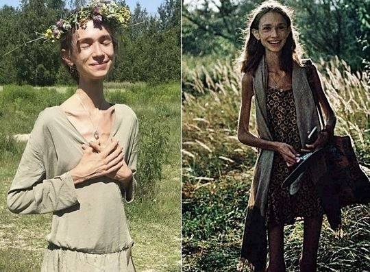 과일식을 시작한 뒤 그는 영양 결핍 증상을 겪은 것으로 전해졌다. 인스타그램