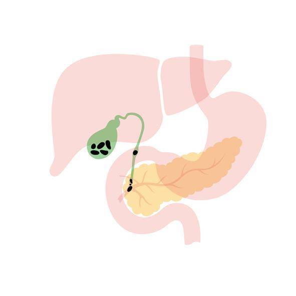 담낭과 담석. 게티이미지뱅크