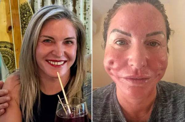 영국 출신의 53세 리 코브는 비숙련 시술자에게 실리프팅을 받은 후 부작용으로 얼굴에 구멍이 생겼다./사진=영국 더 선(the sun) 캡처