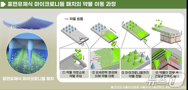 (서울=뉴스1) 강승지 기자 = 반복적인 주사 치료로 불편을 겪는 환자들을 위해 다양한 비침습적 약물 전달 기술이 개발되는 가운데 최근 국내 연구진이 주사 없이 패치 하나로 대용량의 약물을 주입할 수 있는 기술을 개발했다. 사진은 표면유체식 마이크로니들 패치의 약물 이동 과정.(서울아산병원 제공)