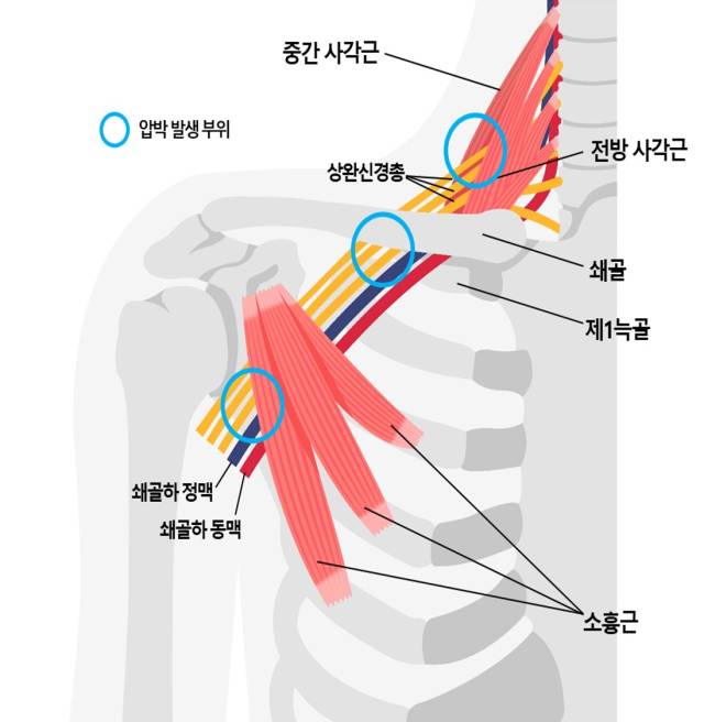 흉곽 출구 증후군에서 신경 혹은 혈관이 눌리는 부위. 사진 제공=서울대병원