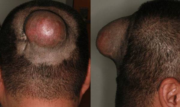 두피에 난 혹이 점점 커지더니, 결국 암을 진단받은 40대 남성의 사례가 보고됐다./사진=큐레우스