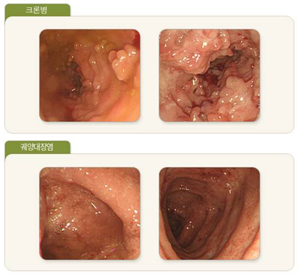 내시경으로 본 크론병과 궤양성대장염 환자의 대장. 국가건강정보포털