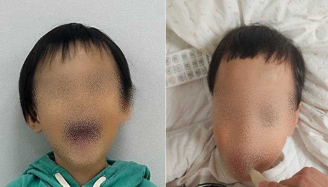 대전 유성구의 한 어린이집에서 귀가한 B(3)군의 머리카락이 잘려오는 등 아동학대 의혹이 불거졌다. 사진은 아동의 머리카락이 잘리기 전 후 모습. 학부모 제공