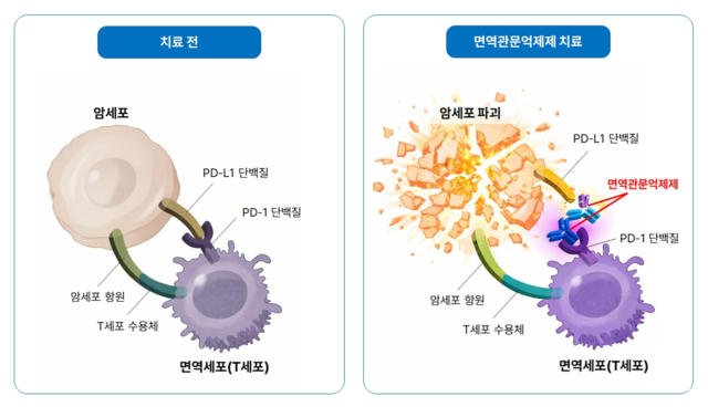 면역관문억제제는 PD-L1과 PD-1 결합을 막아 면역세포가 암세포를 공격할 수 있도록 돕는다. 분당서울대병원
