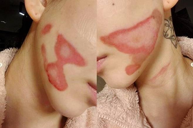 피부과 의료 시술 피해를 고백한 권민아 SNS