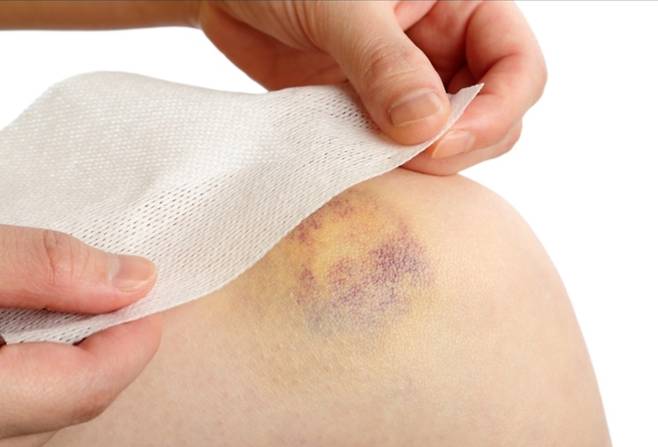 ▲타박상이나 염좌 증상 완화에 효과가 있는 파스. 사진=바른세상병원 블로그