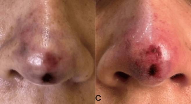 코 필러 시술 후 코에 부작용이 나타난 모습. 오른쪽이 더 나중 사진으로 증상이 악화되는 양상이 보인다. 사진=큐레우스(Cureus)