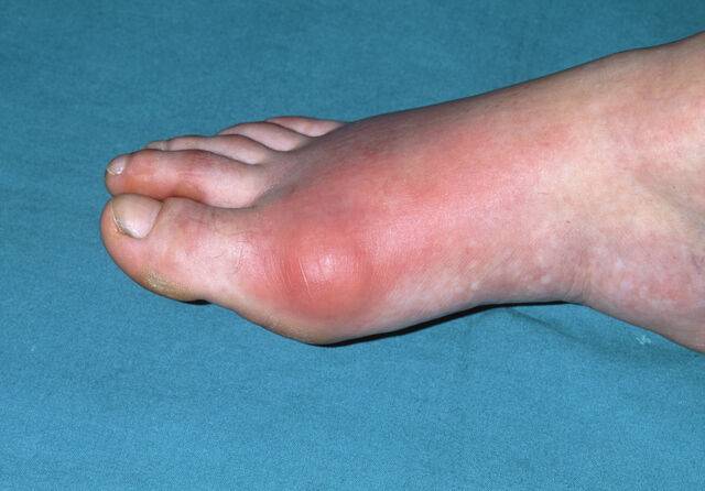 통풍은 보통 엄지발가락이나 발등 등에 욱신거리는 통증으로 시작된다. 클립아트코리아