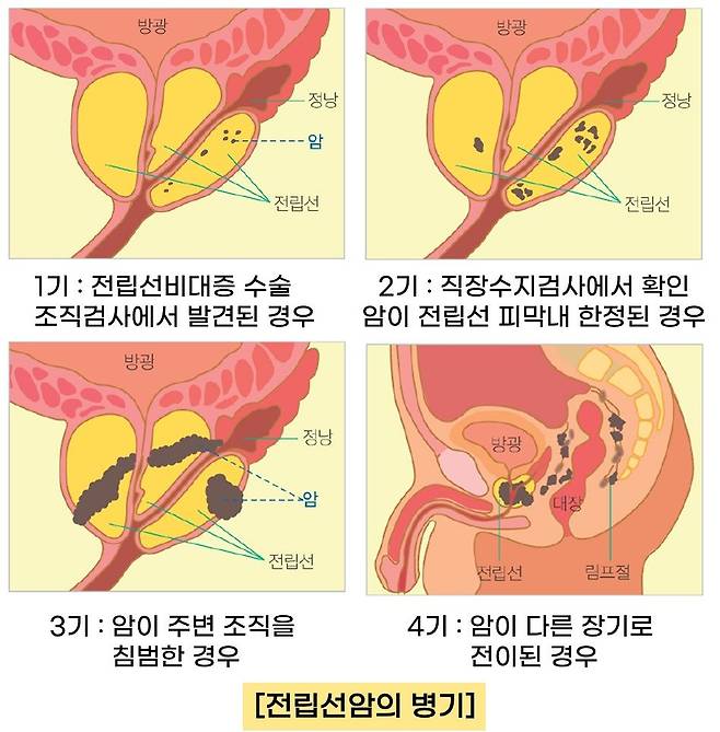 전립선암 병기별 특징. 자료 서울아산병원