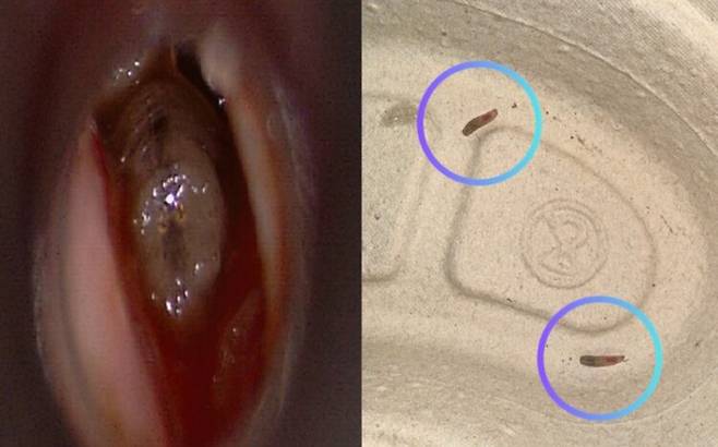 80대 여성의 귀안에 보이는 구더기 유충(왼쪽). 귀 안에서 제거한 유충 세 마리 중 두 마리(오른쪽). 사진=이비인후과 증례보고