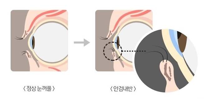 안검내반으로 눈꺼풀이 안으로 말려들어가면 속눈썹이 각막을 지속적으로 자극해 손상을 입힐 수 있다. 건강보험심사평가원 제공