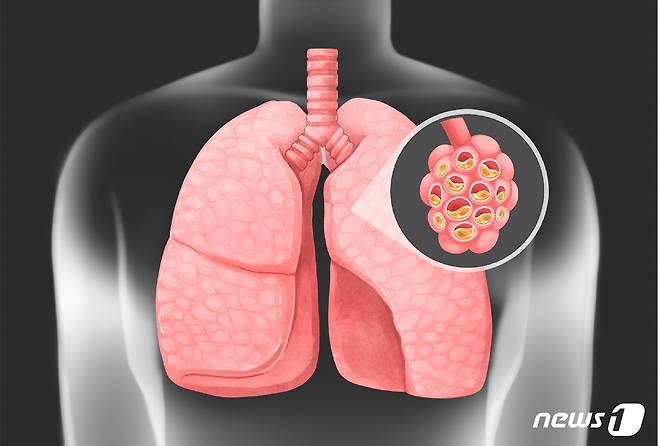 만성 폐쇄성 폐질환은 이런 폐포와 기도에 만성 염증과 이로 인해 구조적 변화가 생겨 공기의 흐름이 제한되는 질환이다. 숨이 차고, 일상생활이 점차 어려워진다. 증상이 서서히 진행되기 때문에 본인이 변화를 크게 느끼기 힘들다. 진단될 때 이미 폐 기능이 상당히 떨어져 있다. ⓒ 뉴스1 윤주희 디자이너