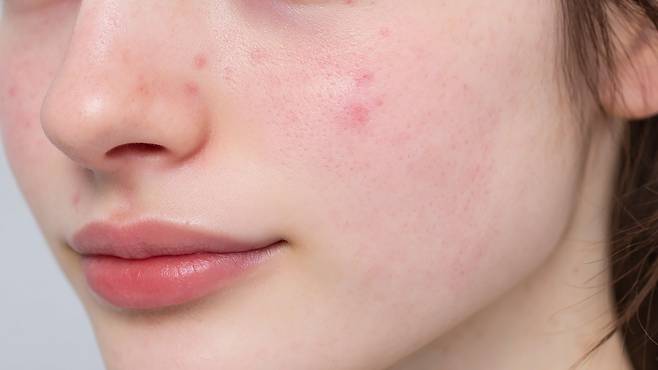 조금만 자극받아도 트러블이 생기는 '민감성 피부'가 고민인 사람들이 있다|출처: 클립아트코리아