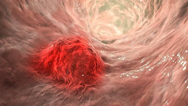 대장내시경은 단순 진단을 넘어 치료와 예방 효과까지 겸비한 검사이다|출처: 클립아트코리아