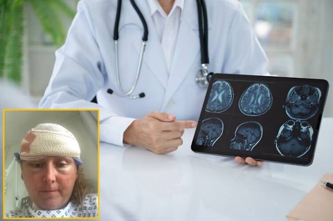 갱년기로 인한 증상인 줄 알았으나, 뒤늦게 뇌수막종으로 인한 증상임을 알게 된 여성의 사연이 소개됐다. 뇌수막종은 뇌와 척수를 둘러싸고 있는 수막에서 발생하는 종양이다. 배경사진=게티이미지뱅크/좌측 하단 사진=SNS