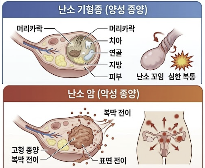 난소암