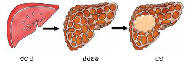 ▲출처=대한간암학회 홈페이지