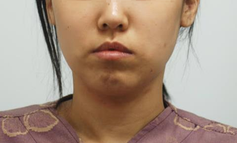 '중안면 긴 얼굴' 이라고 부르는 얼굴들을 살펴보면 결국 그 본질은 '하관이 부족한 얼굴굴'입니다. 사진=슈어스성형외과